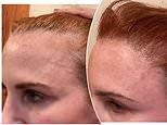 Why more women than ever are opting for hair transplants at an eye-watering cost