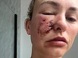 Dog owner who feared she would be scarred for life after her pet attacked her face 'can look in the mirror again' after pioneering treatment