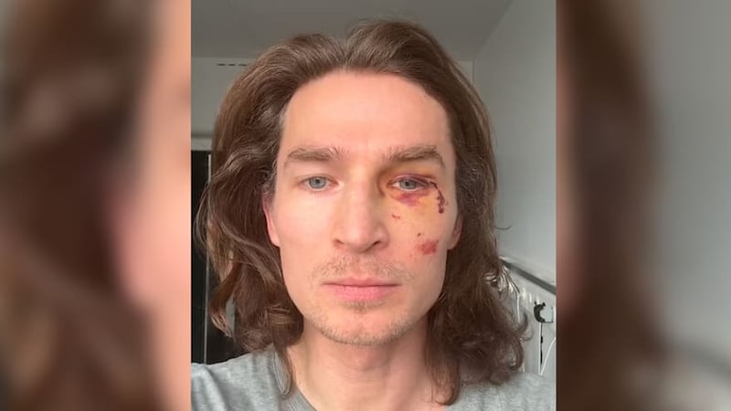 Nach Blut-Sturz - Snowboard-Star zeigt seine neue Augenhöhle