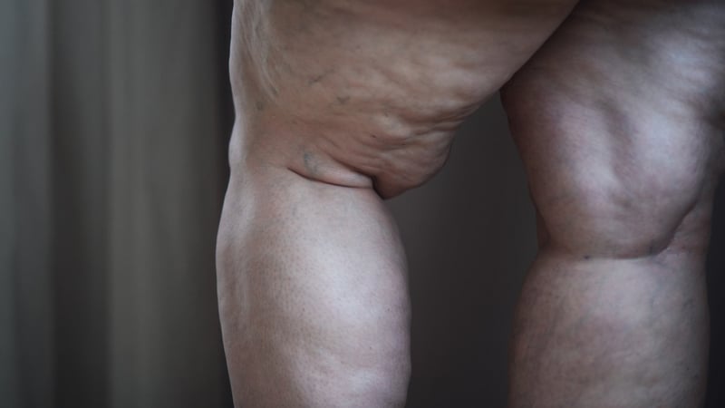 Warum Frauen mit Lipödem oft jahrelang auf die richtige Behandlung warten