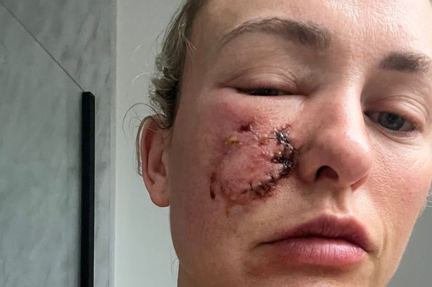 Woman bit by her own dog can 'look in mirror again' after laser treatment