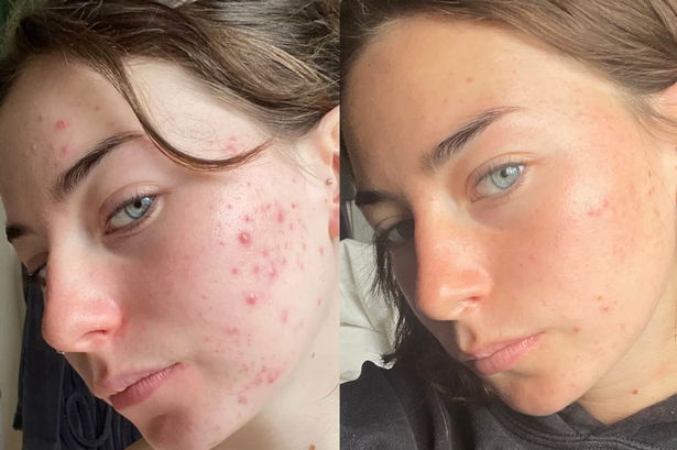 Award-winning serum bringing 'hope' back to bad skin sufferers now £24