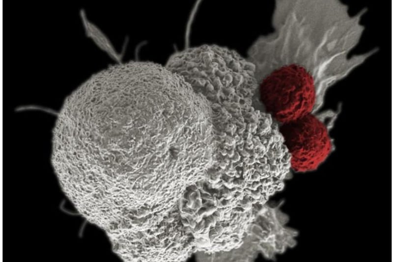 Common virus found in most people can trigger lupus, study reveals