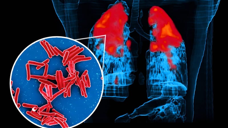WHO-Bericht: Tuberkulose bleibt 2025 tödlichste Infektionskrankheit