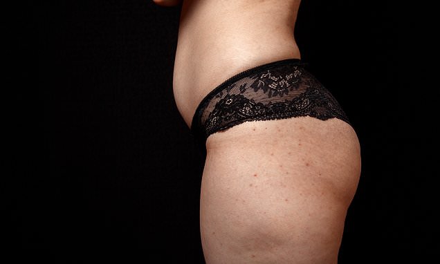 Suffering from spots on your bum? A skin expert reveals the little-known condition behind it - and what you can do to zap those unsightly red bumps