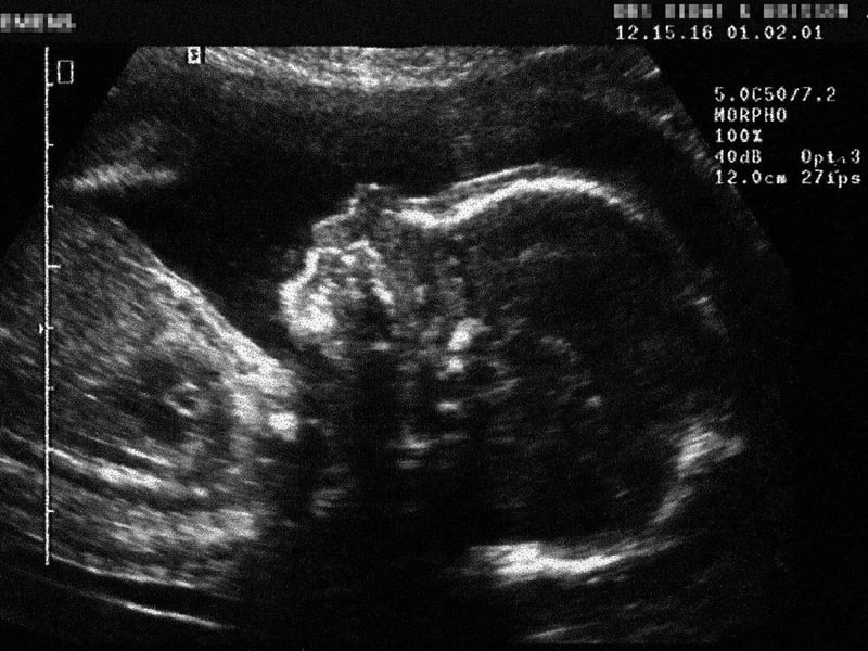 Late-term abortions are being performed in Canada without a serious medical reason