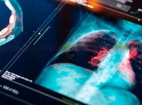 Akciğer kanseri neden sigara içmeyenlerde görülüyor?