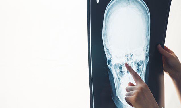 Fast care after head injury can dramatically cut risk of developing dementia